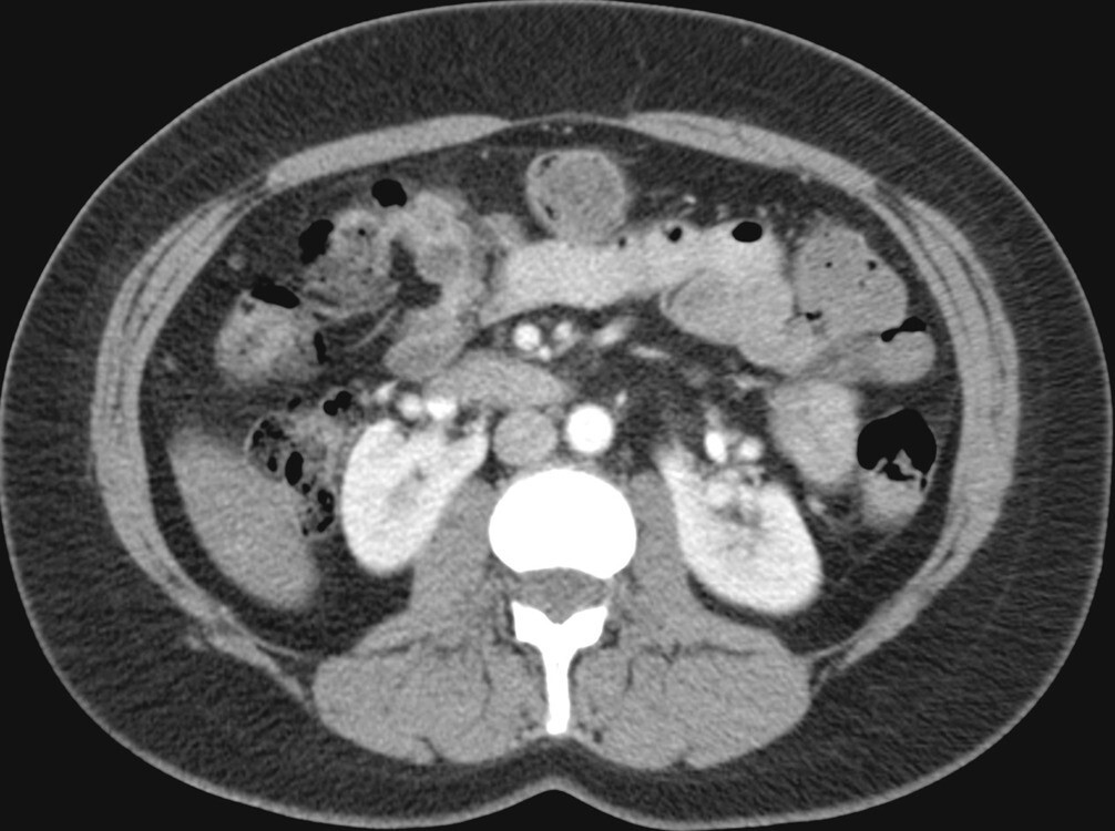 A 38-year-old woman who underwent contrast-enhanced computed tomography for vague abdominal pain.